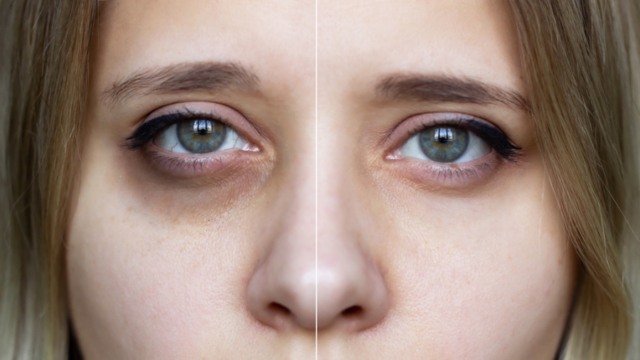 ใต้ตาคล้ำ มีร่องน้ำตา มีถุงใต้ตา ริ้วรอยรอบดวงตา ปัญหาแบบไหน? รักษาอย่างไร ?