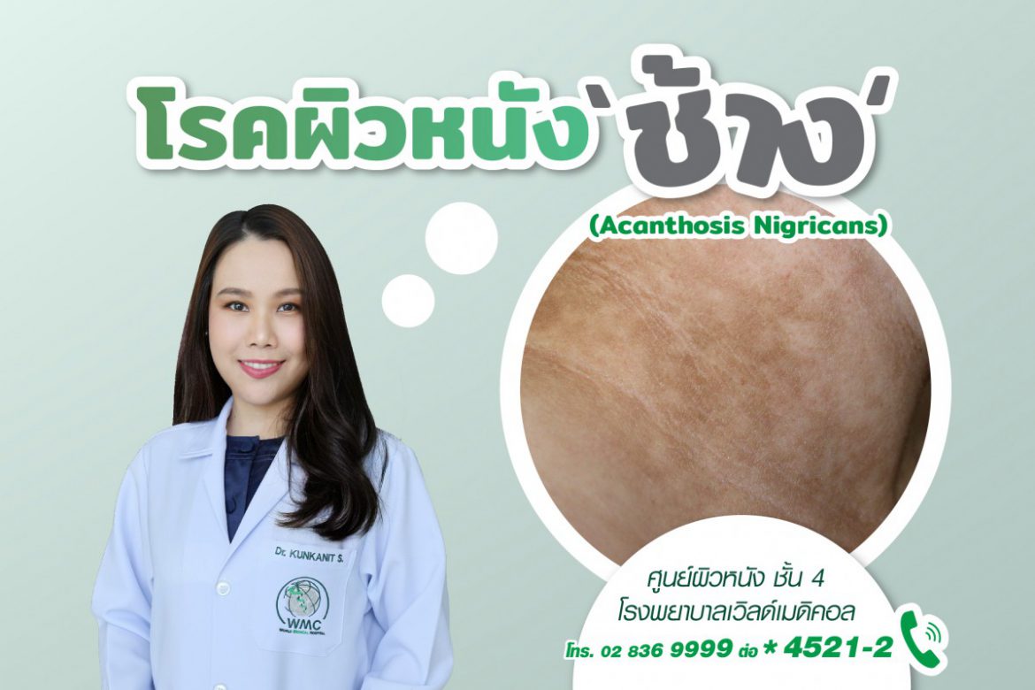 โรคผิวหนังช้าง (Acanthosis Nigricans)