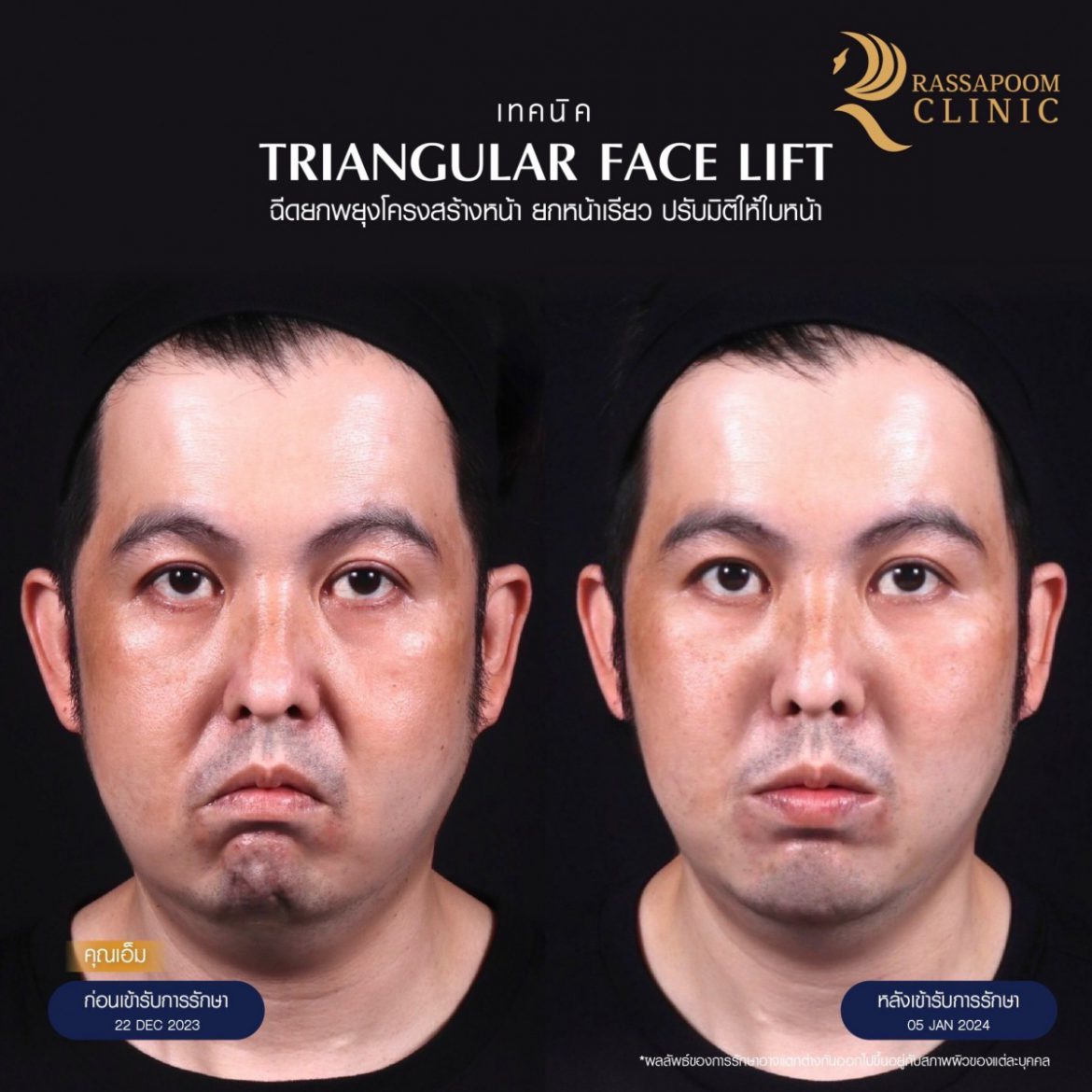 เปลี่ยนอารมณ์ของใบหน้าให้ดูละมุน อ่อนวัยและดูดีขึ้น ด้วยเทคนิค Triangular Face lift